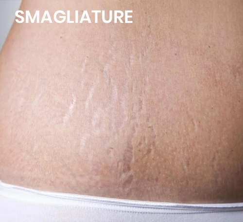 smagliature su fianco
