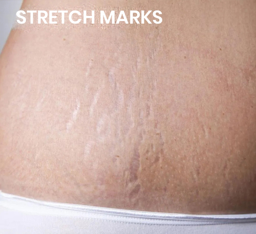 stretch marks