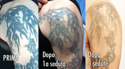 Rimozione laser dopo tre sedute su tatuagio vecchio di 20 anni