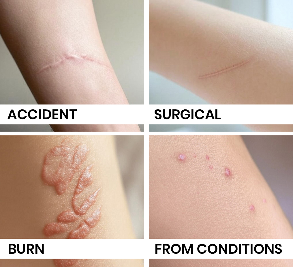 different tipe of scars: accident scars, surgical scars, burn scars and scars from conditions